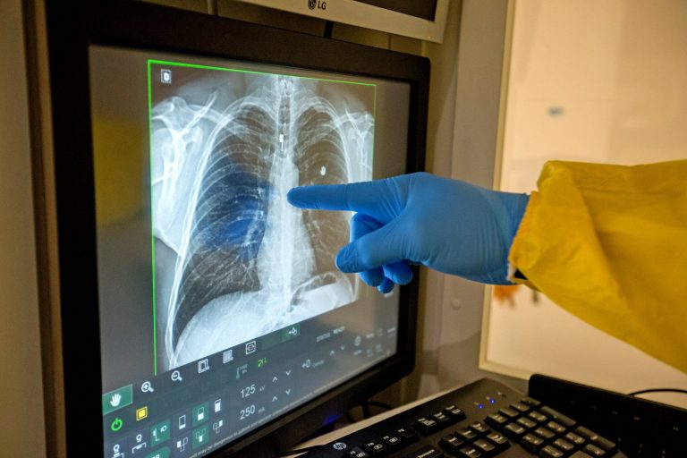 Sechelele din organism pe care le lasă în urmă infecția cu COVID-19
