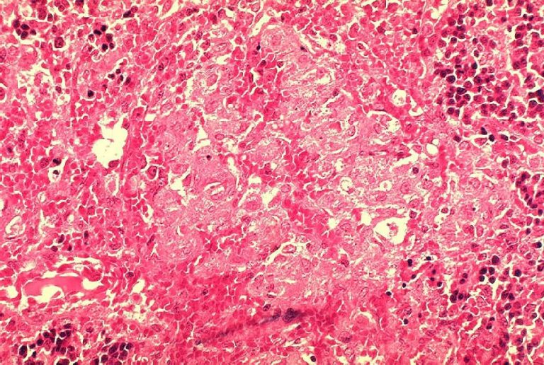 Mai mult de 3.000 de îmbolnăviri după ce o bacterie a fost scăpată dintr-un laborator din China