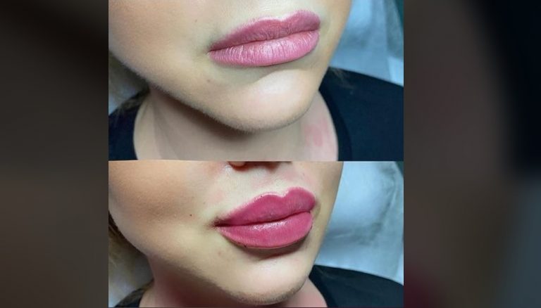 My Lips Lie. Russian ‘plastic surgeon’ who ‘botched dozens  of operations ’ in Romania investigated for posing as medic