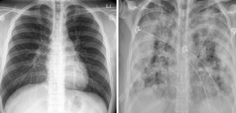 FOTO | Diferenţa șocantă între plămânii unui bolnav COVID nevaccinat şi cei ai unui vaccinat