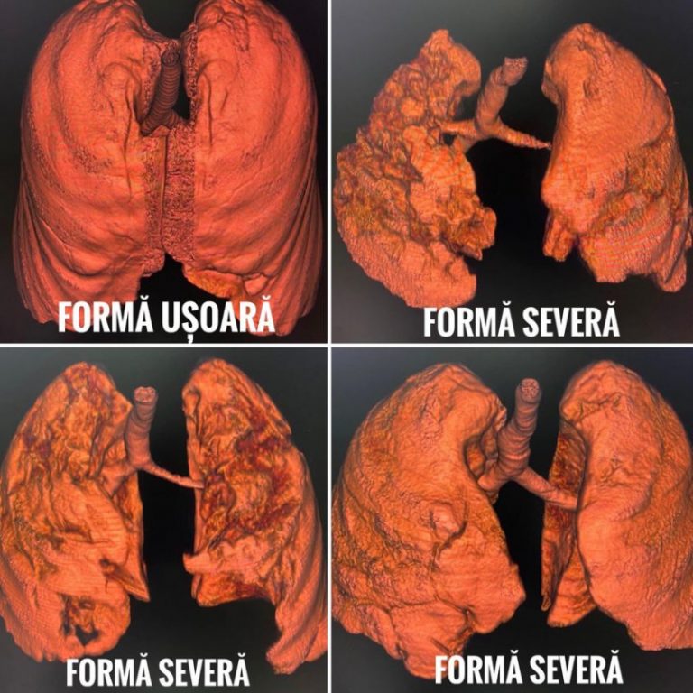 CNCAV a publicat tomografiile computerizate a 4 pacienți nevaccinați bolnavi de COVID-19