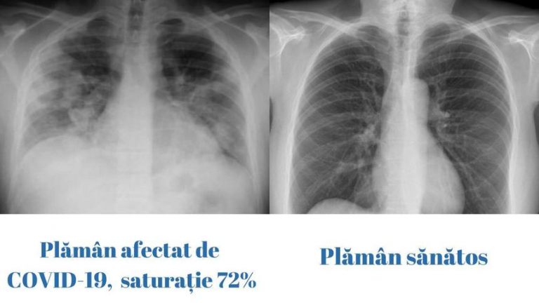 FOTO | Diferenţa dintre un plămân sănătos şi unul afectat de Covid la un pacient de 23 de ani
