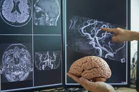 A fost descoperită cauza progresiei maladiei Alzheimer