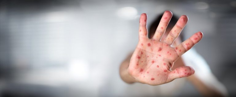 Un copil a murit din cauza rujeolei la câțiva ani după ce se îmbolnăvise