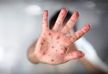 România, pe primul loc în UE la numărul de cazuri de rujeolă la copii