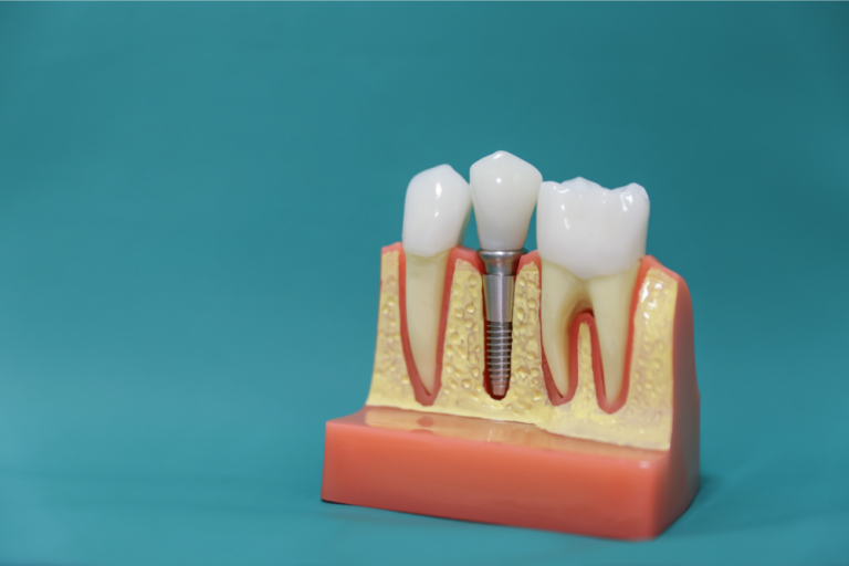 Implantul dentar: o dantură funcţională şi un zâmbet strălucitor
