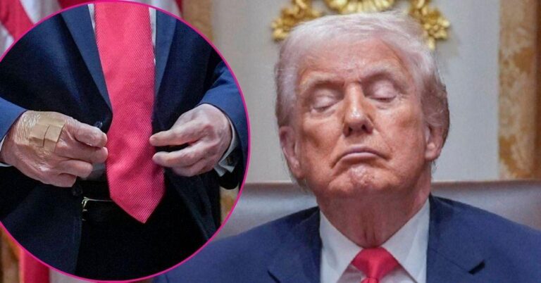 Trump poartă un pansament, iar Casa Albă invocă din nou strângerile de mână